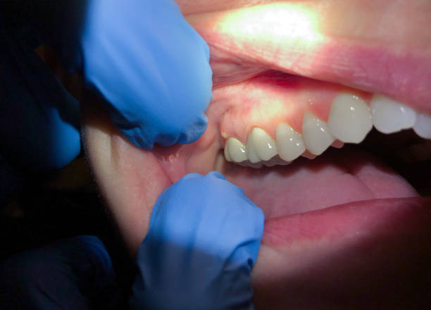 Best Knocked-Out Tooth Emergency  in Sylvan Springs, AL